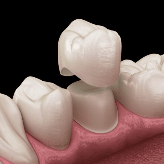 Dental Crowns in Ventura